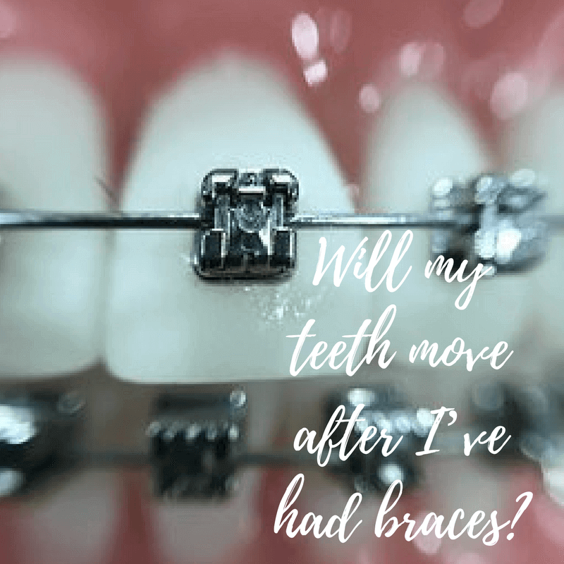 WillmyteethmoveafterIEFBFBDvehad2