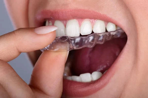 Clear Aligners Sydney