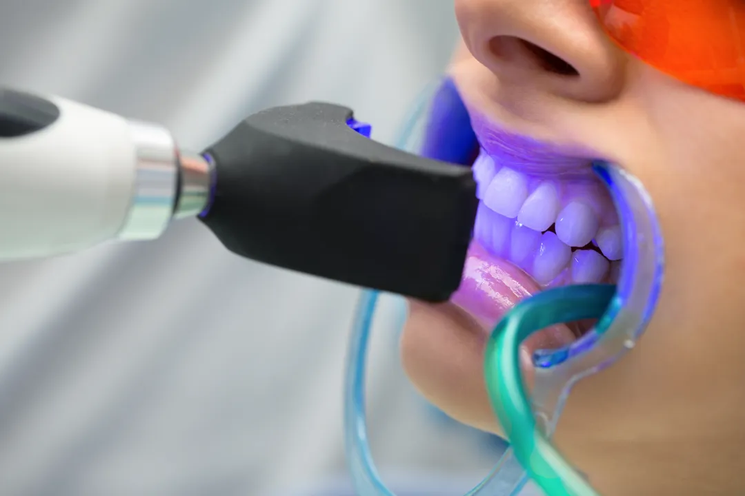 Teeth Whitening Ryde
