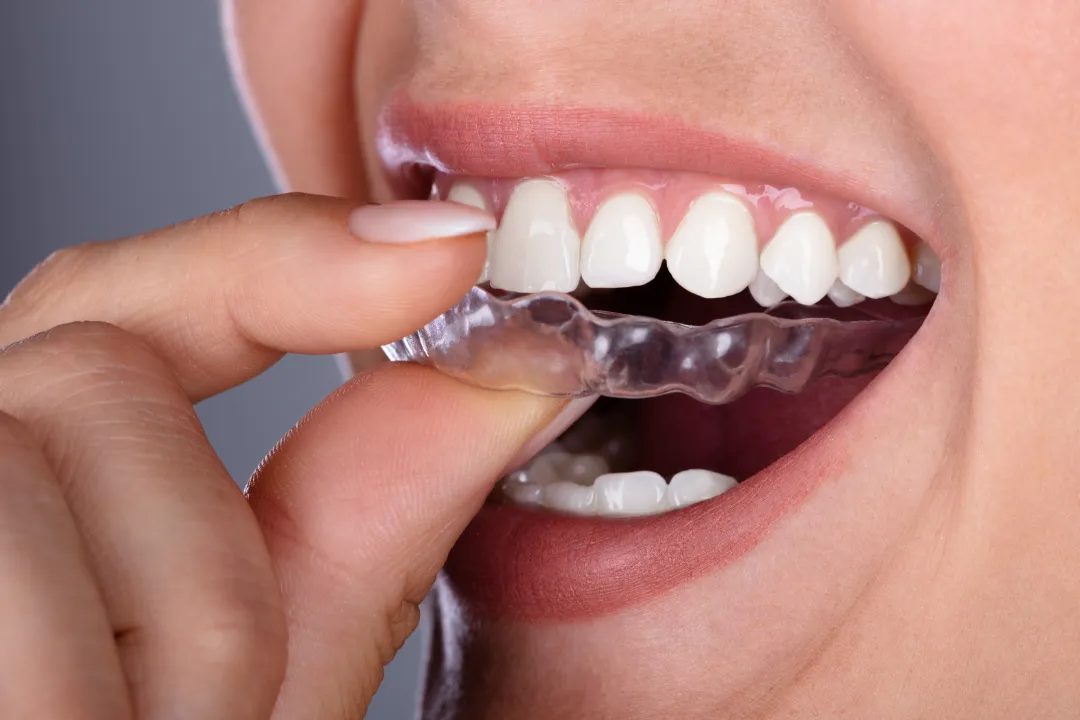 Clear Aligners Sydney