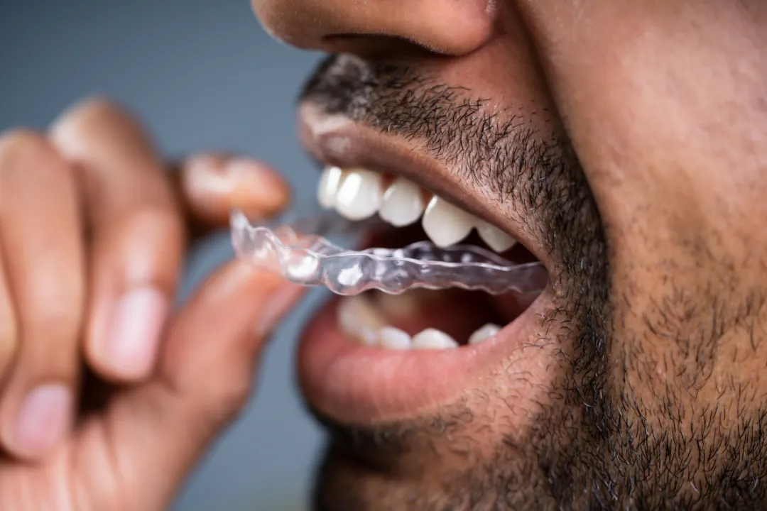 Clear Aligners Sydney